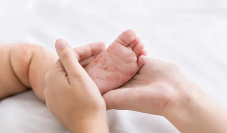 乳幼児湿疹